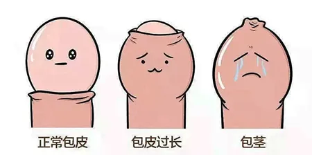 男宝包皮嘅三种情况